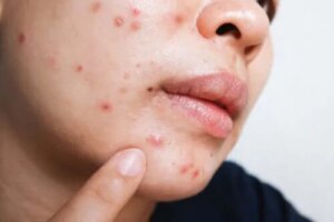Isotretinoin pentru acnee: beneficii și efecte adverse