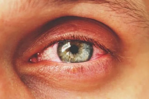 Ochii roșii sunt simptomele uveitei