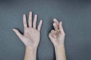 Cauzele și tratamentul contracturii Dupuytren