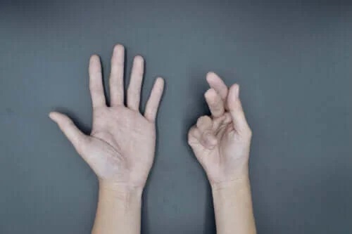 Cauzele și tratamentul contracturii Dupuytren