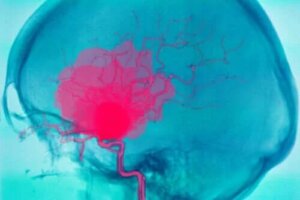Care este tratamentul hemoragiei intracerebrale?