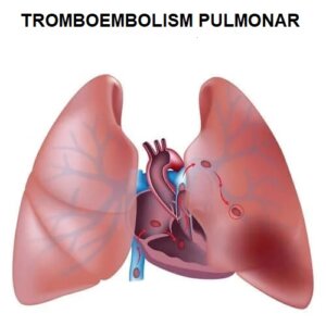 Tratamentul tromboembolismului pulmonar