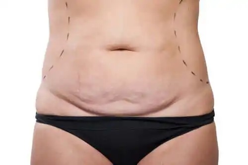 Ce este abdominoplastia