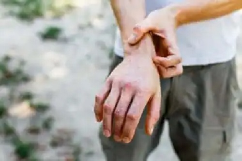 Bărbat care are nevoie de tratamentul granulomului anular