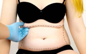 Ce este abdominoplastia?