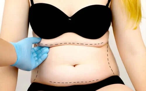 Ce este abdominoplastia?
