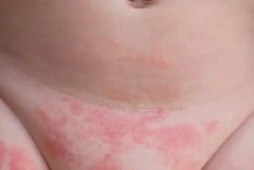 Dermatita de scutec