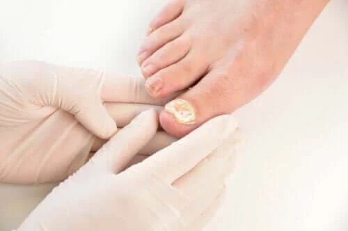 Infecțiile fungice ale unghiilor: prevenire