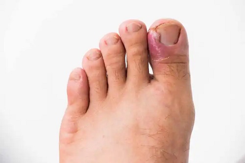 Infecțiile fungice ale unghiilor de la picioare