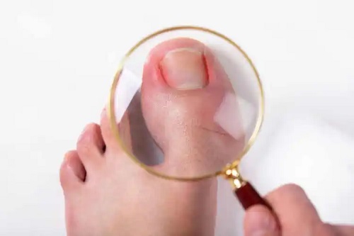 Infecțiile fungice ale unghiilor