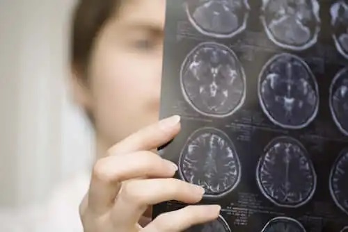 Medic care stabilește diagnosticul atrofiei multisistemice