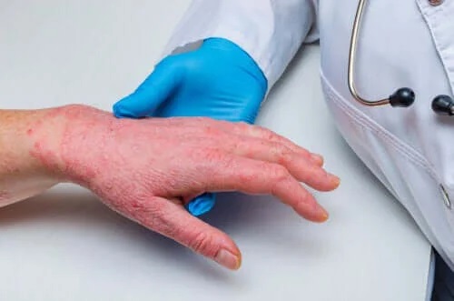 Legătura dintre psoriazis și bolile coronariene