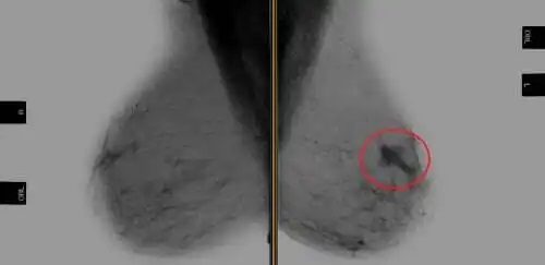 Radiografie necesară în tratamentul cu Trastuzumab