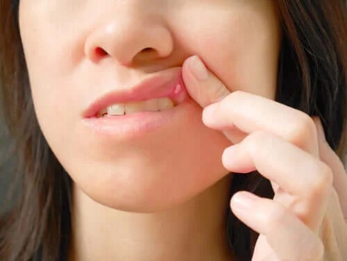 Cauzele și tratamentul aftelor bucale