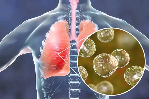 Tuberculoza afectează plămânii