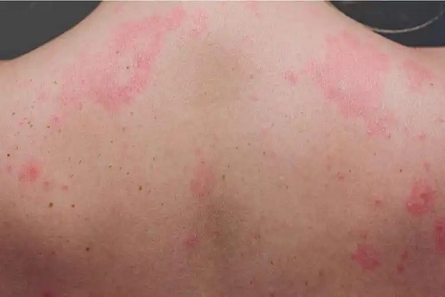 Alergie la cohoș negru