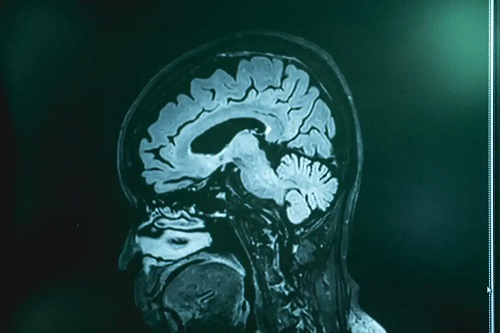 Infecția cu Naegleria Fowleri văzută la RMN