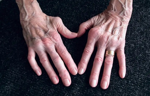Mâini afectate de artrita reumatoidă
