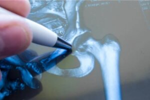 Fractura de șold: tot ce trebuie să știi