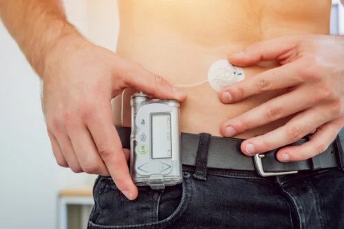 Ce este pompa de perfuzie cu insulină?