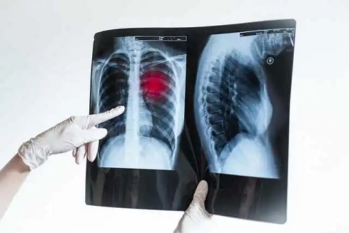 Sechlele după pneumonie văzute la radiografie