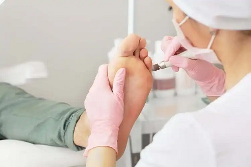 Tratamente medicale pentru calusuri