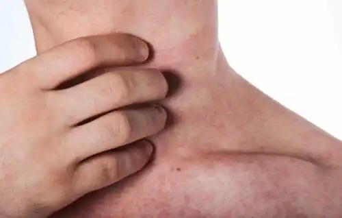 Persoană care nevoie de tratamentul alergiei la latex