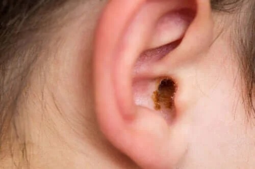 Tratamentul dopurilor de ceară din urechi