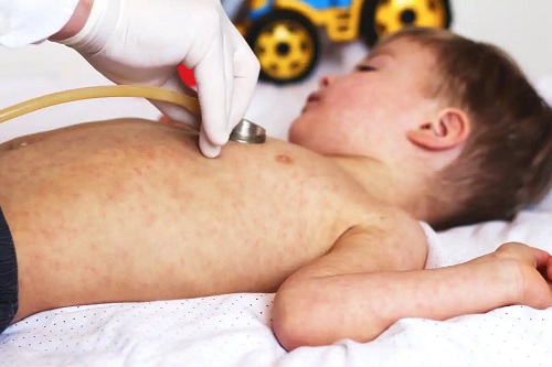 Coil care nu a primit vaccinul contra rubeolei
