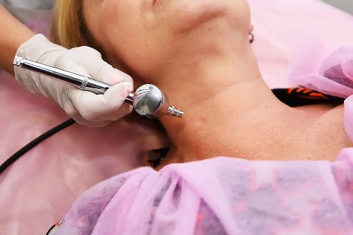 Femeie care face tratament cu dermapen