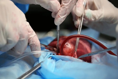 Specialiști care efectuează operația pe cord deschis