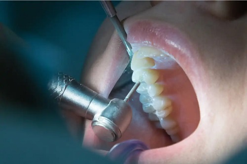 Traumatismul dentar reparat la medic