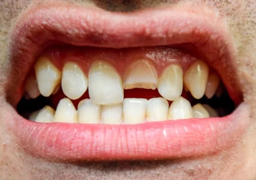 Traumatismul dentar: ce este și ce tipuri există?