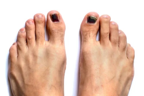 Unghiile negre la picioare: cum să le tratați?