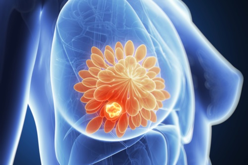 Vaccinul contra cancerului de sân a vindecat un pacient
