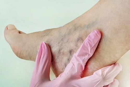 Boli cauzate de purtarea tocurilor la nivelul picioarelor