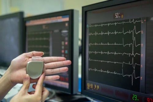 Ce este un stimulator cardiac și cum funcționează?