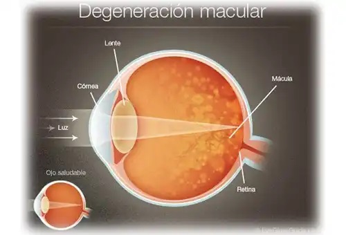 Degenerescența maculară la om