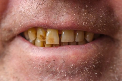 Dinți afectați de tutun