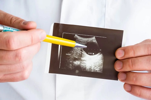 Rezultate date de o ecografie testiculară