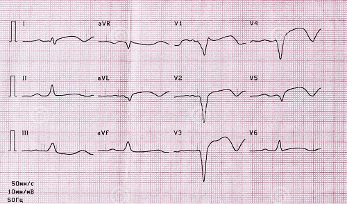 Rezultatele unui EKG