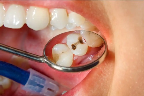 Carii dentare