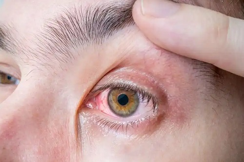 Melanomul ocular: simptome și cauze