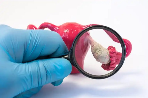 Tipuri de cancer ginecologic