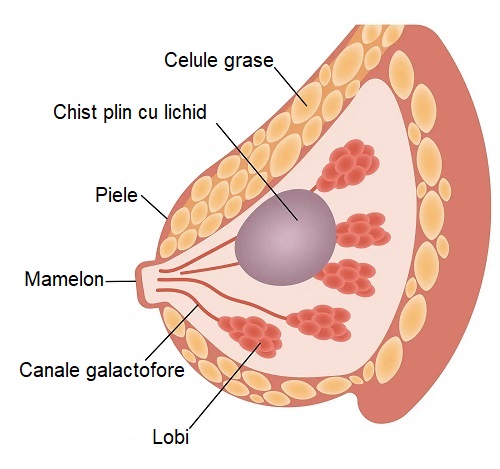 Chisturile la sâni