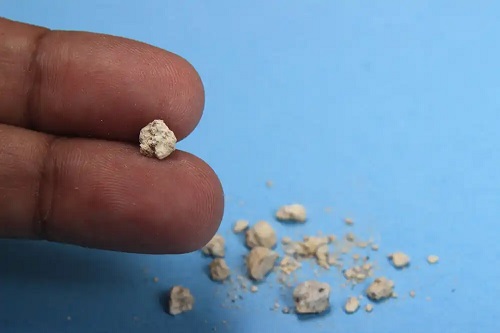 Calculi renali
