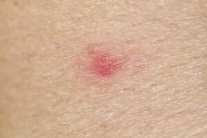 7 remedii naturale pentru a ameliora mușcăturile de purici