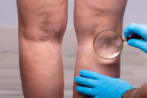 Durere în spatele genunchiului | Cauza, diagnostic, simptome, tratament și sfaturi