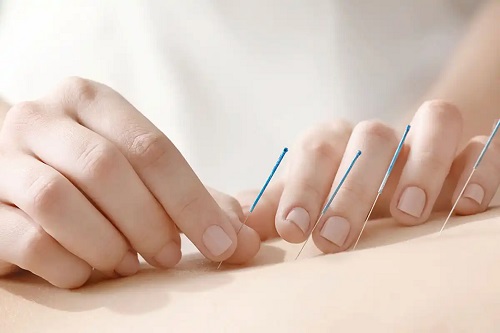 Acupunctură folosită în medicina integrativă