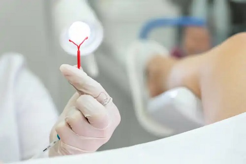 Ce este dispozitivul intrauterin și pentru ce este?